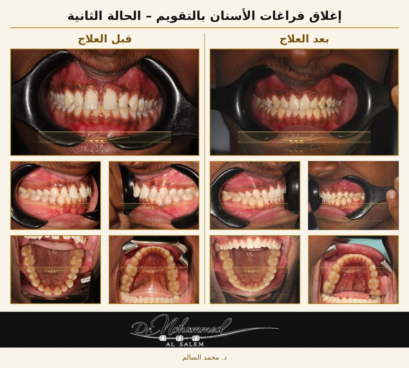 قبل وبعد علاج فراغات معمّمة وتنسيق الأسنان بالتقويم مع خطة تثبيت طويلة المدى.